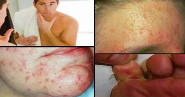 8 COMMON SKIN PROBLEMS IN MEN AND HOW TO TREAT THEM NATURALLY